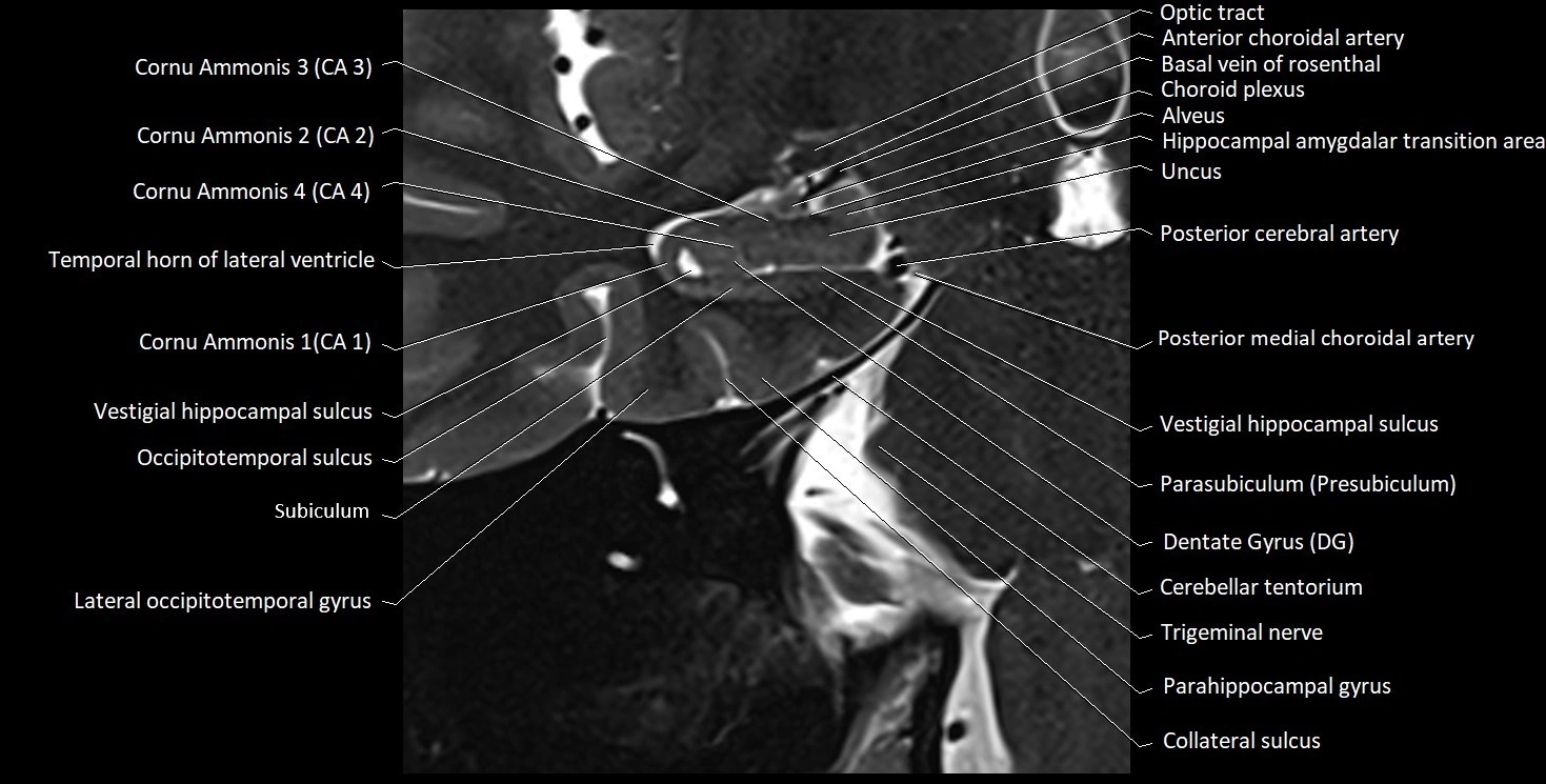 Hippocampus anatomy mri coronal cross section 3T MRI image 6.webp